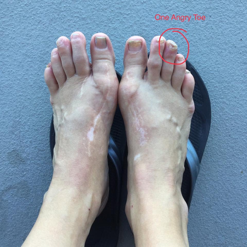 Top-down view of my two bare feet on flip-flops against a gray wall, faint surgical scars visible, with a hand-drawn red circle and the words 'One Angry Toe' pointing at a single discolored toenail.