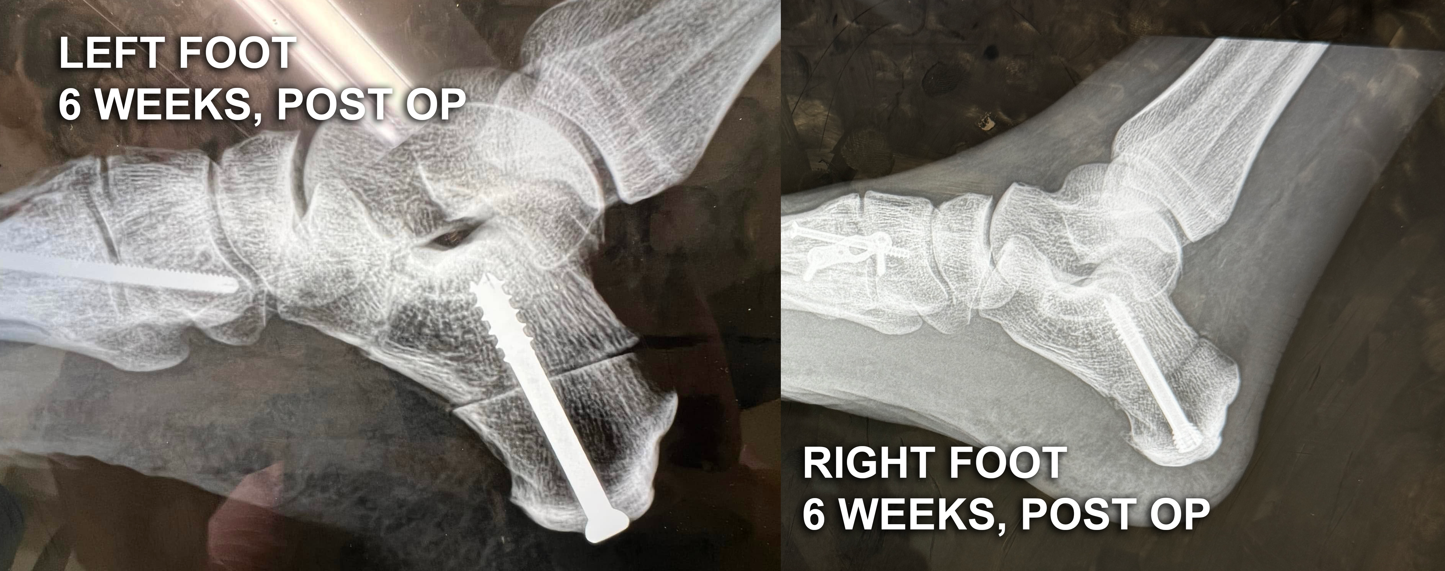 A side-by-side of two lateral foot x-rays. Left, labeled 'LEFT FOOT 6 WEEKS, POST OP', shows a long bright screw driven down through the heel and a second long screw across the midfoot, with the heel bone still looking unfused. Right, labeled 'RIGHT FOOT 6 WEEKS, POST OP', shows smaller, tidier hardware and a heel that already looks solidly knit together.