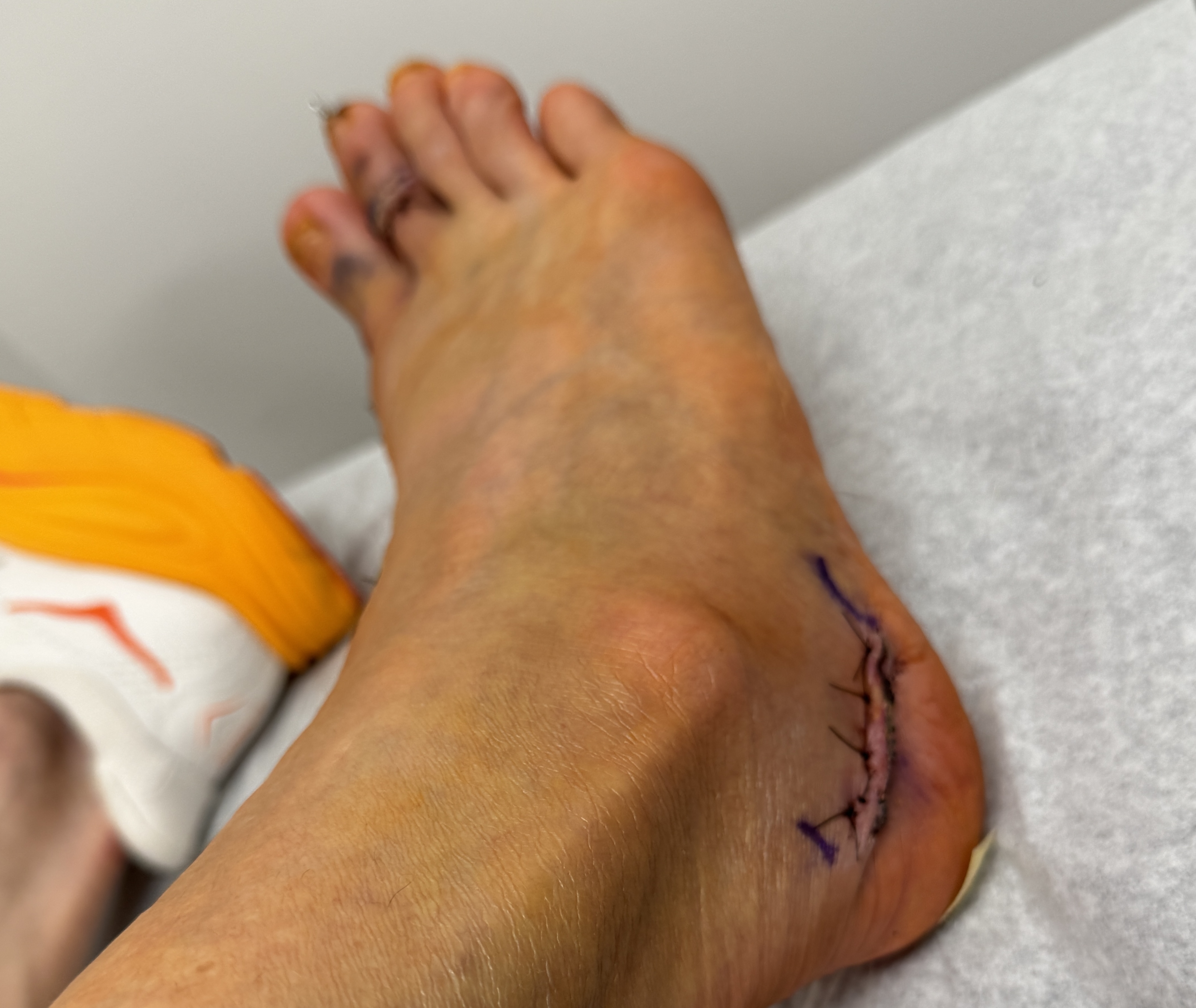 The first reveal: the inside of my right foot and ankle with a curved incision below the ankle bone, closed with black stitches and traced in purple surgical marker, yellow-green bruising fading across the skin.