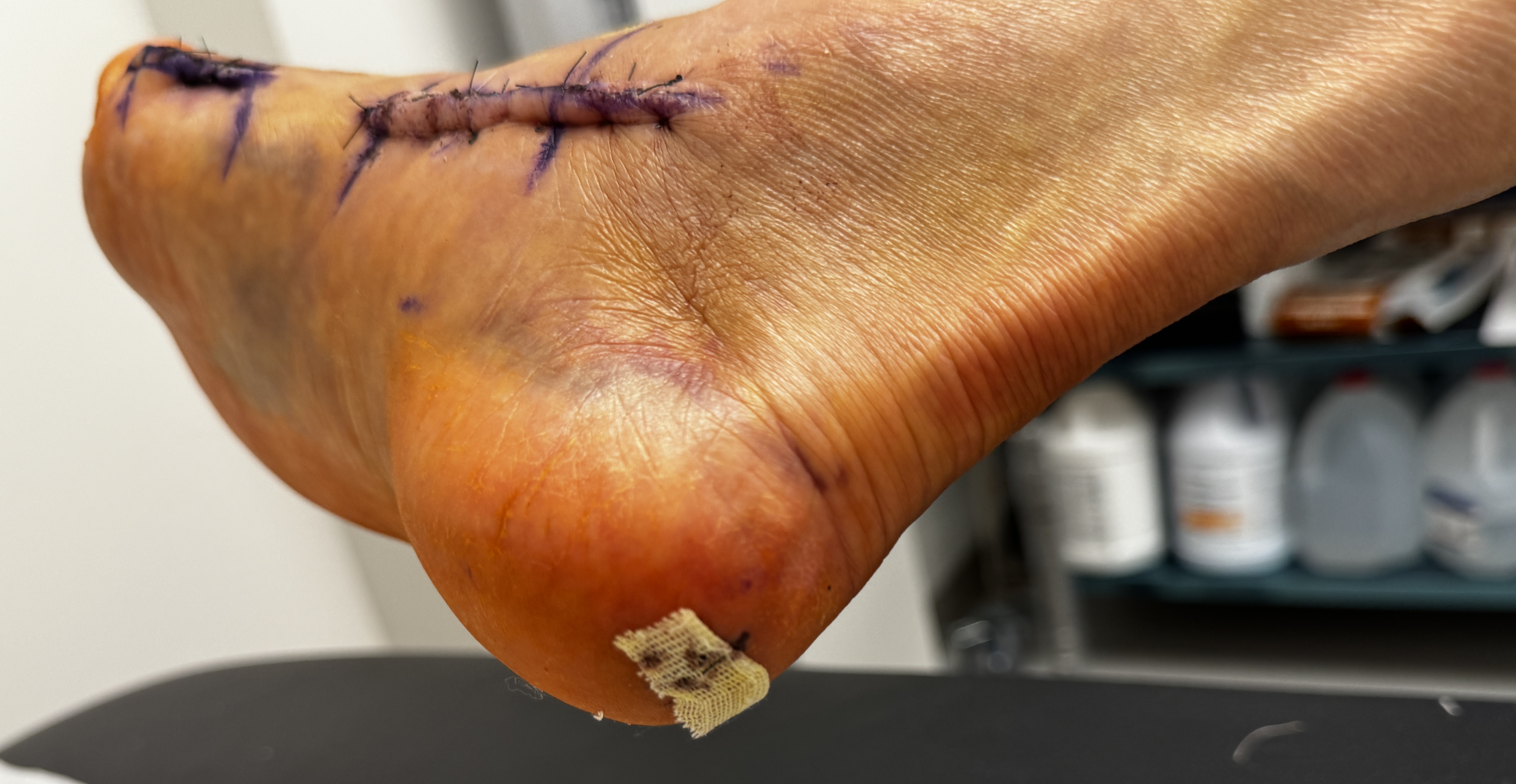 A view from underneath: the sole of my foot with yellow-green bruising across it, a long stitched incision with purple marker running along the edge of my forefoot, and a small mesh bandage stuck to my heel.