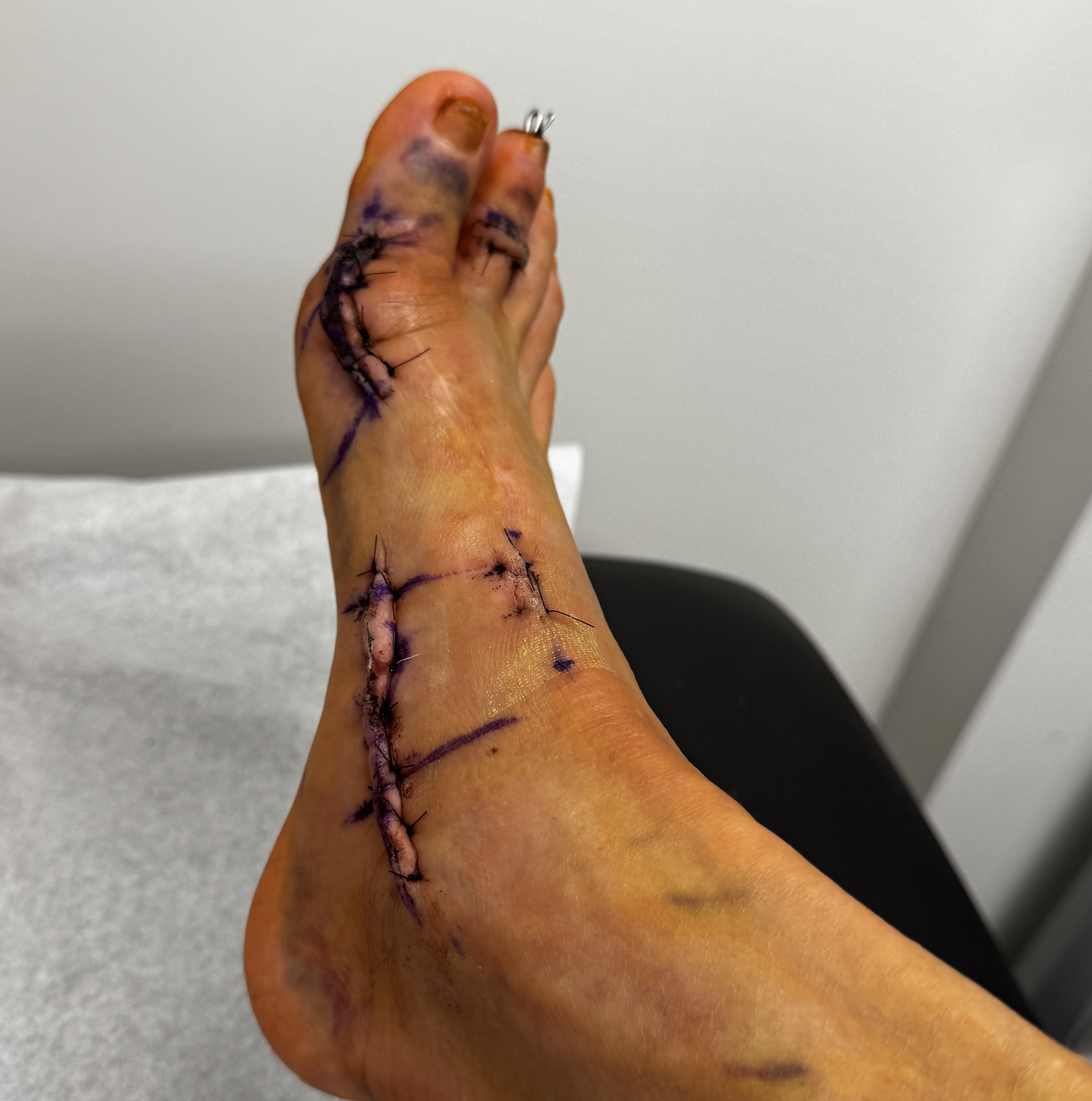 An angled look at the top of my foot: one stitched incision running from my big toe down the top of my foot, another suture line along the inside of my midfoot, purple surgical marker everywhere, bruised toes, and the tip of a metal pin sticking out of my second toe.