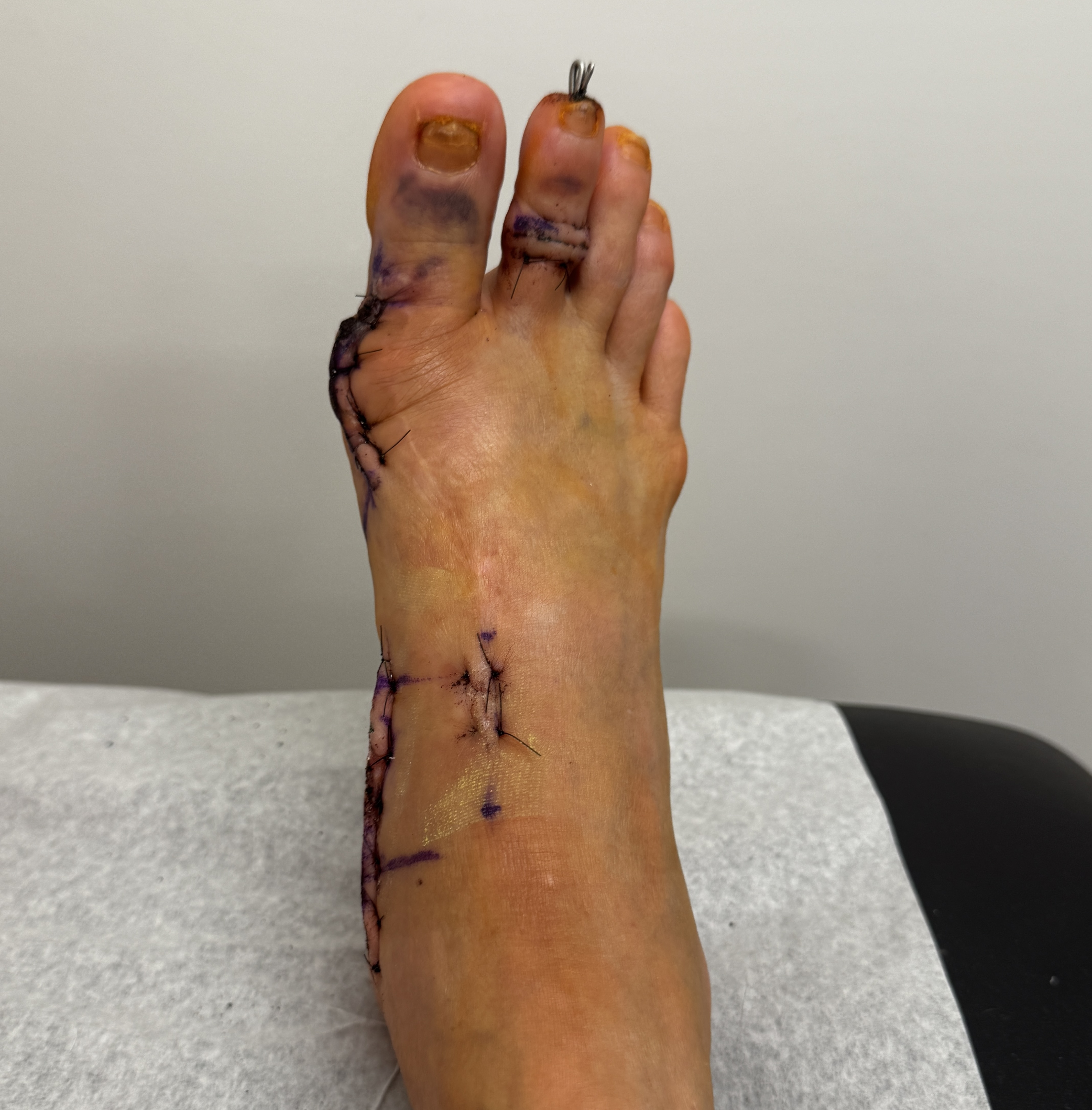 The full top-down view: a bruised big toenail, the wire pin poking out of the tip of my second toe, stitches circling the base of that toe, and two long suture lines running down the inside of my foot with traces of yellow mesh dressing still on the skin.