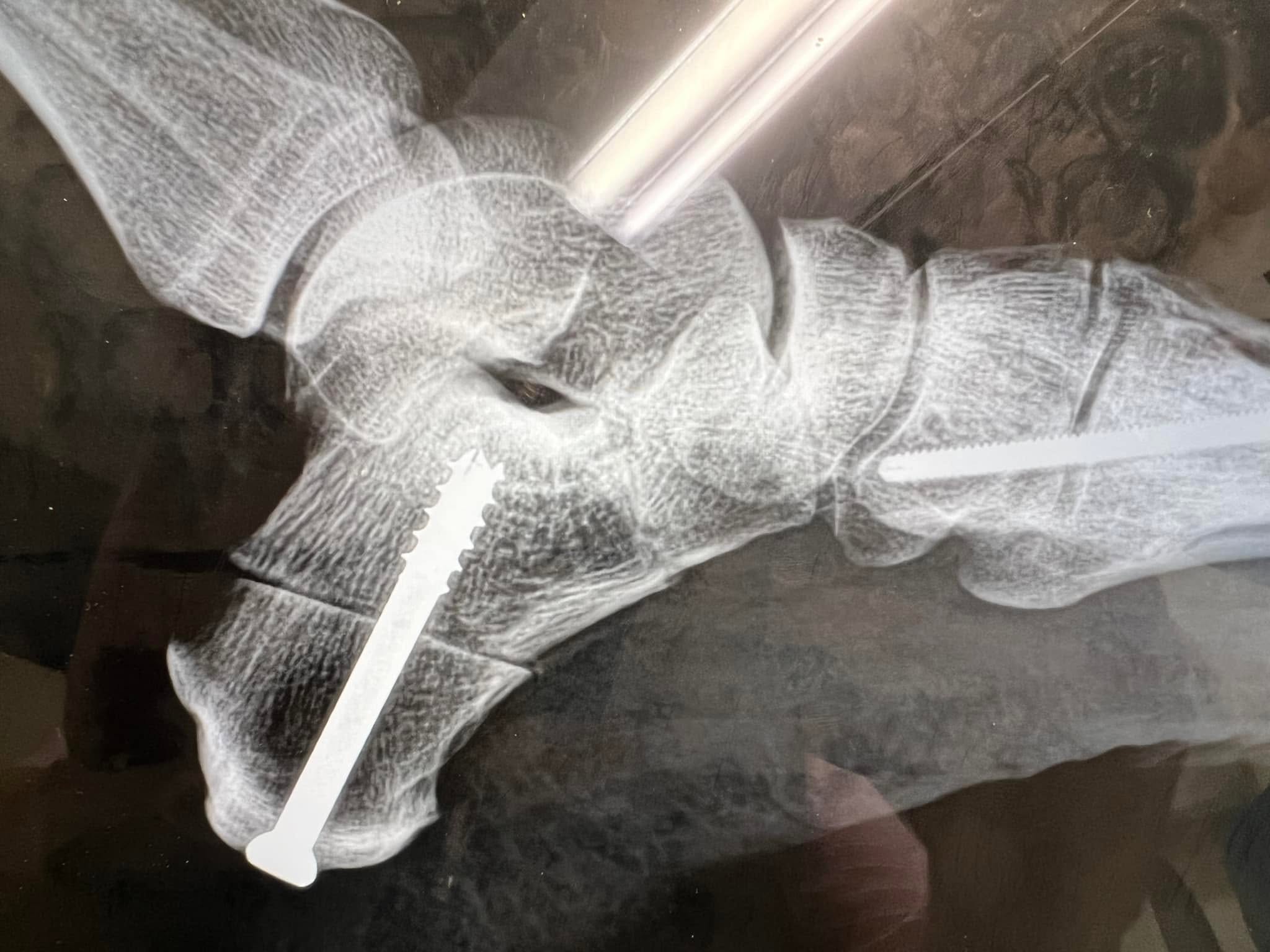 A lateral X-ray of a foot on a lightbox, the heel and midfoot bones held together by two large, bright-white surgical screws; overhead light and a hand are reflected in the glass.