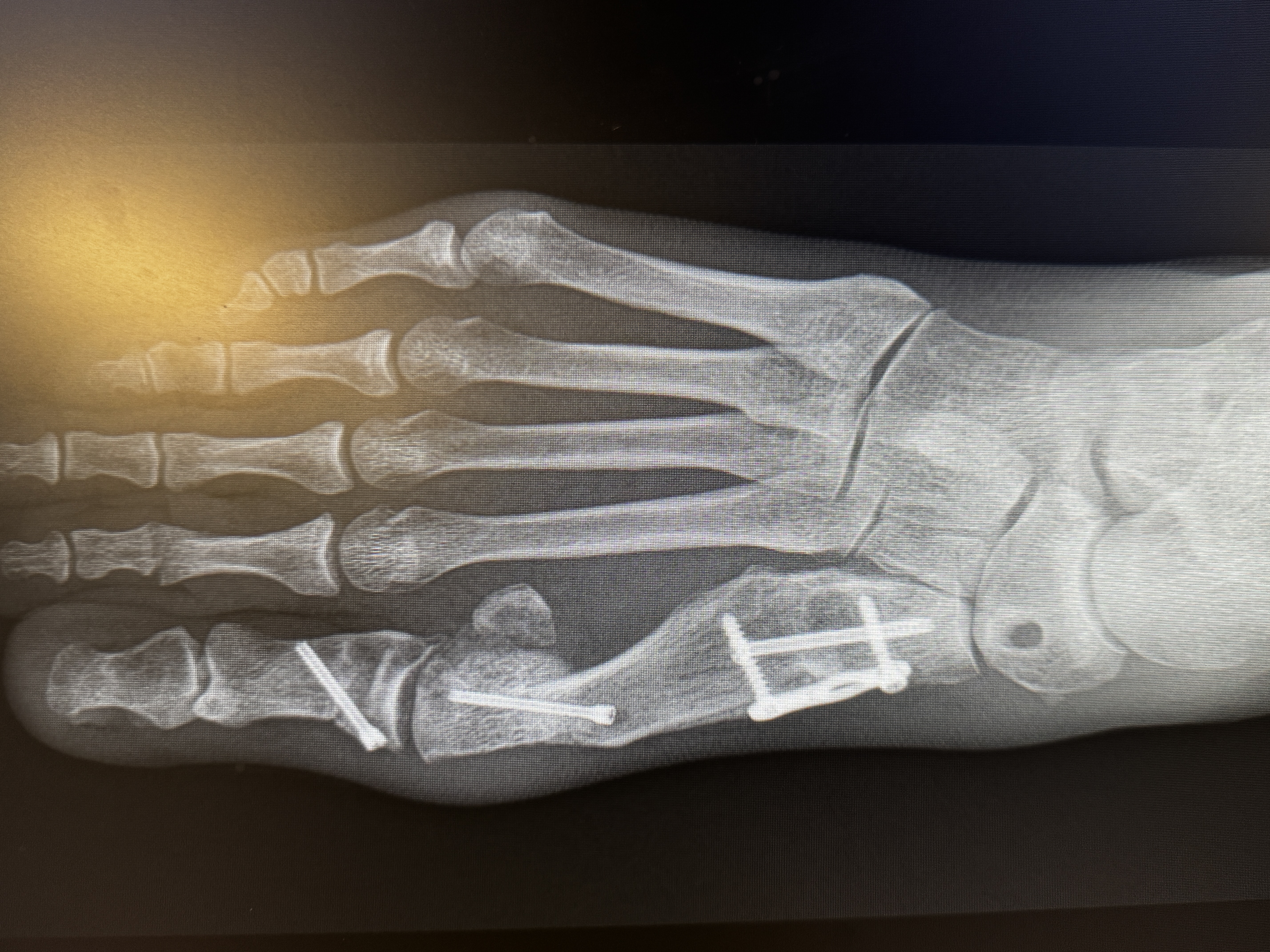 A top-down x-ray of the right foot: a screw angles through the base of the big toe where the bunion was corrected, a small plate and screws run along the inside of the first metatarsal, and the five metatarsals fan down toward the ankle.