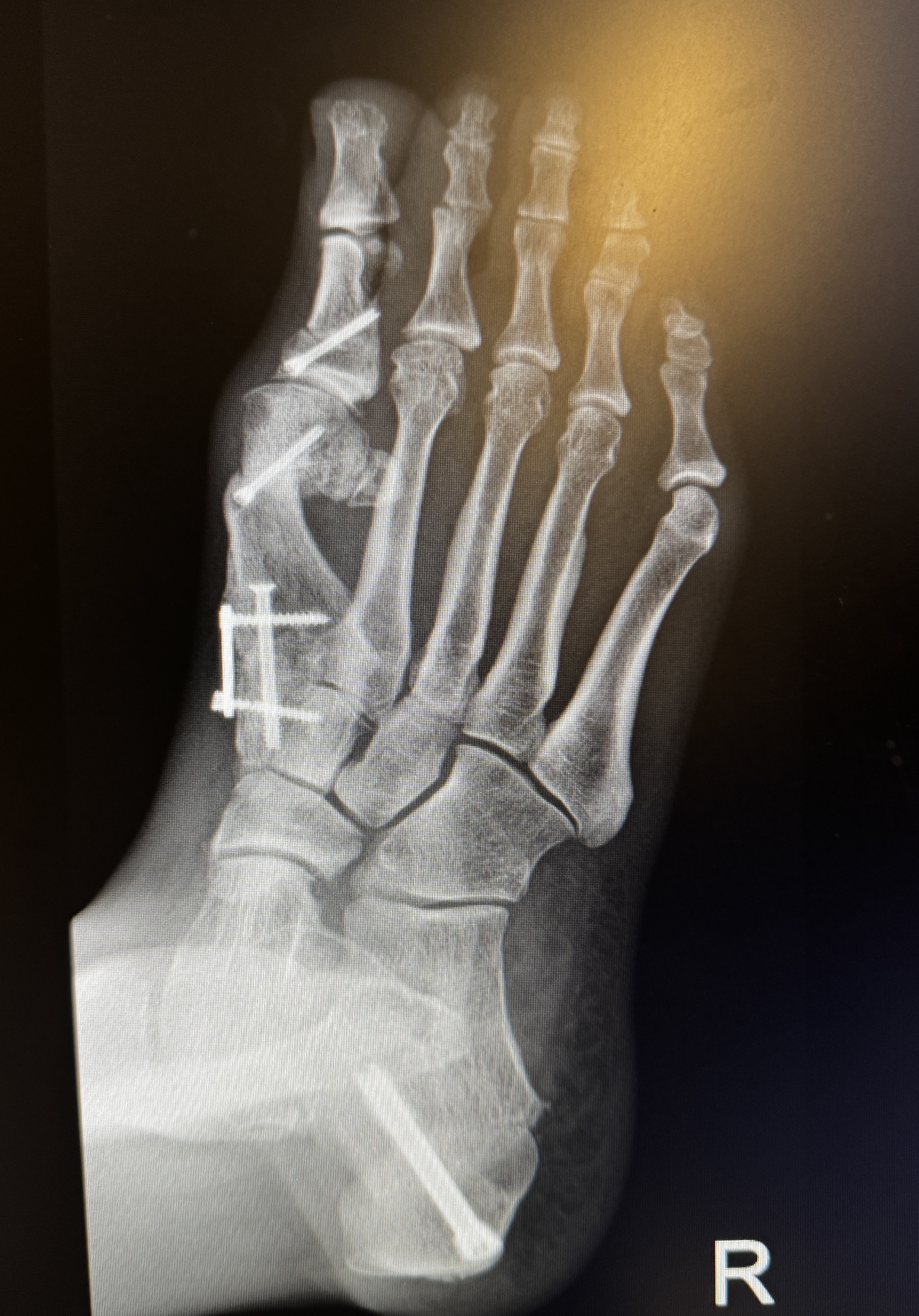 An oblique top-down x-ray of the right foot, marked 'R', showing a screw through the base of the big toe and a small plate with screws down the inner midfoot, the toes fanned out above.