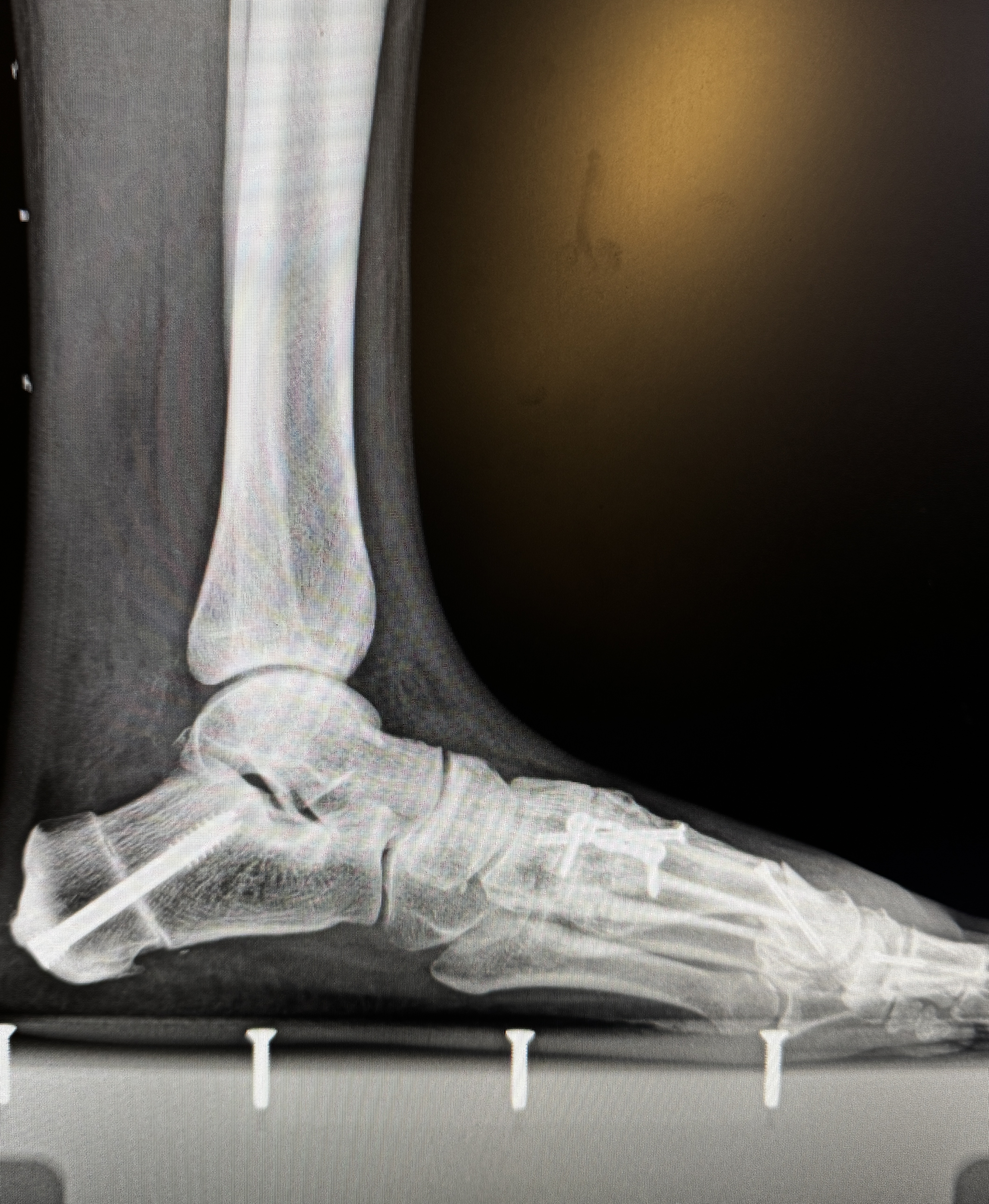 A lateral, side-on x-ray of the right ankle and foot: the tibia and fibula meet the ankle joint, with screws and hardware running through the midfoot and along the arch.