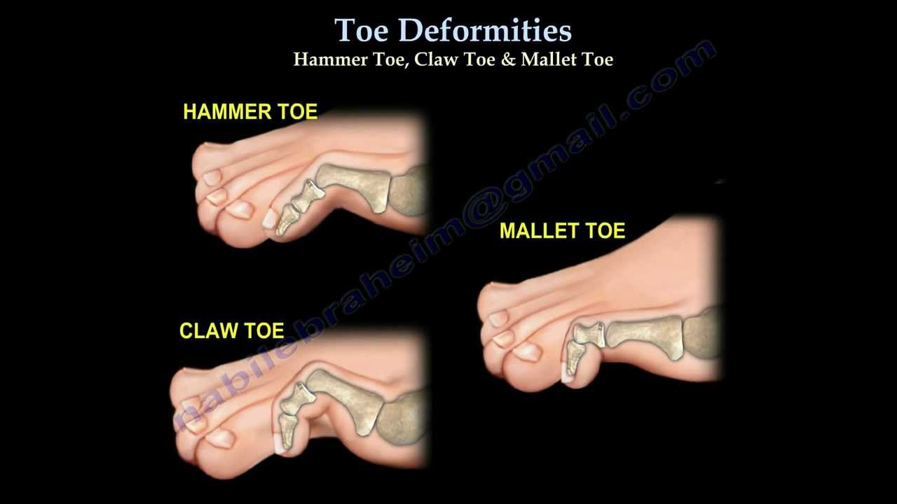 A medical illustration titled 'Toe Deformities' showing three side-view diagrams of a foot with the bones visible: a hammer toe bent at the middle joint, a claw toe curled at both joints, and a mallet toe bent at the joint nearest the tip.