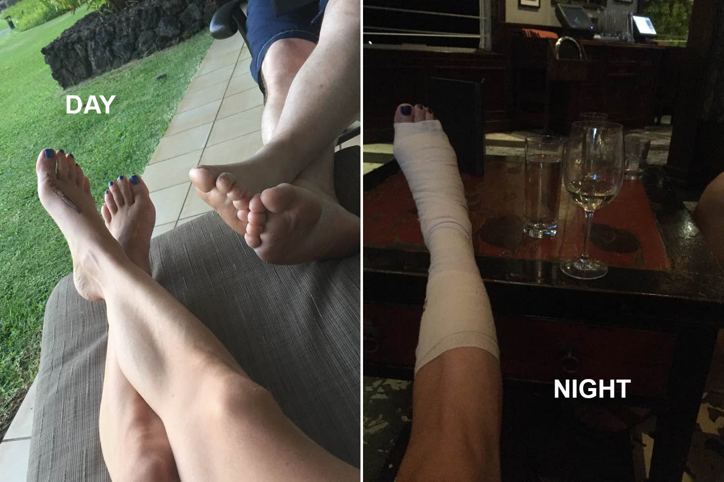 A day-and-night split photo. Left, labeled DAY: two pairs of bare feet propped on a lounge cushion on a patio overlooking a green Maui lawn, blue polish on the toes. Right, labeled NIGHT: a foot wrapped in a beige ACE bandage with blue toenails, resting on a bar table beside a glass of white wine and a water glass.
