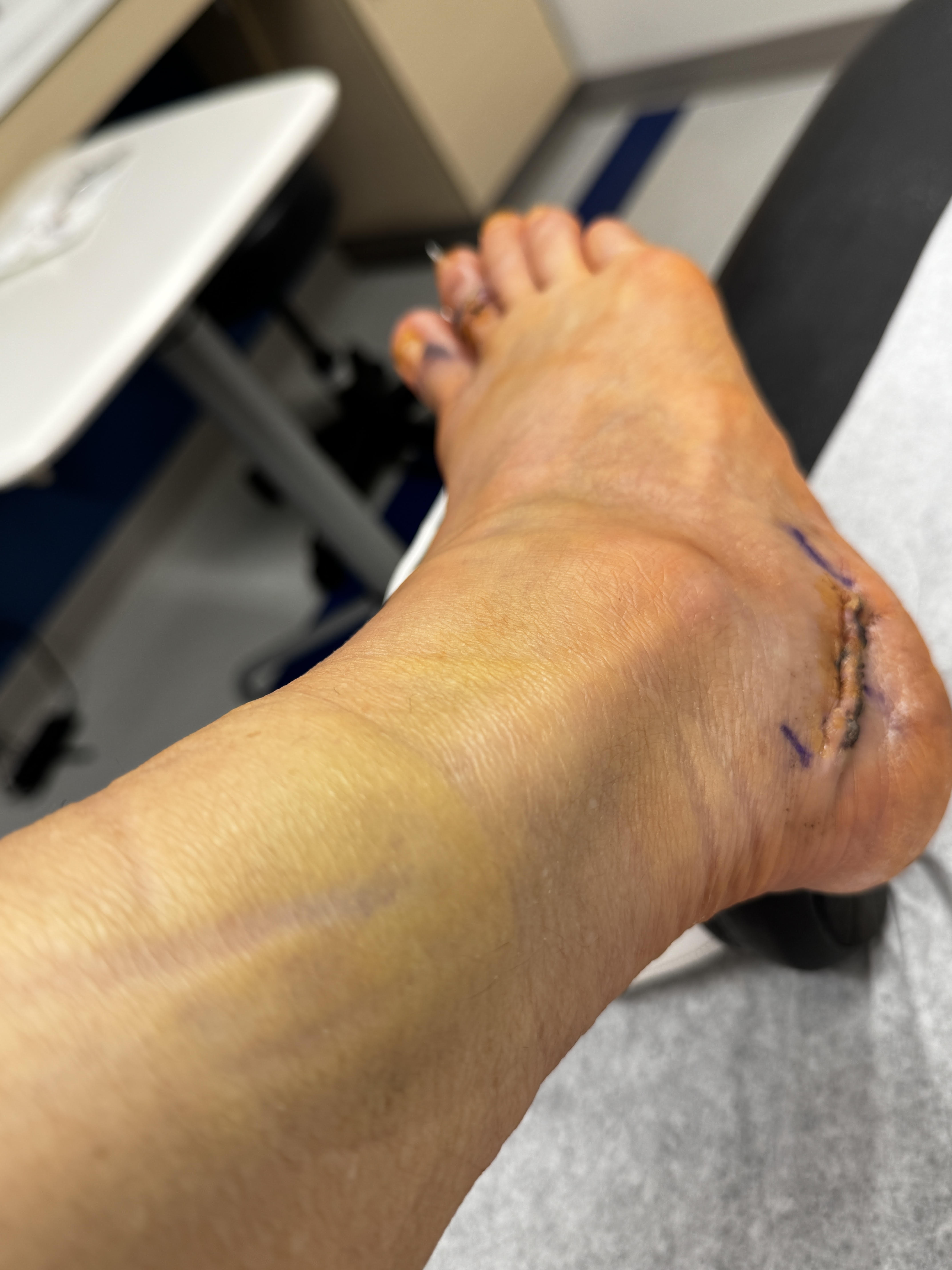 Looking down my shin at the outside of my right foot: a healing incision, scabbed over but free of threads, curving along the outside edge above my heel, with yellow-green bruising washing up over my ankle.