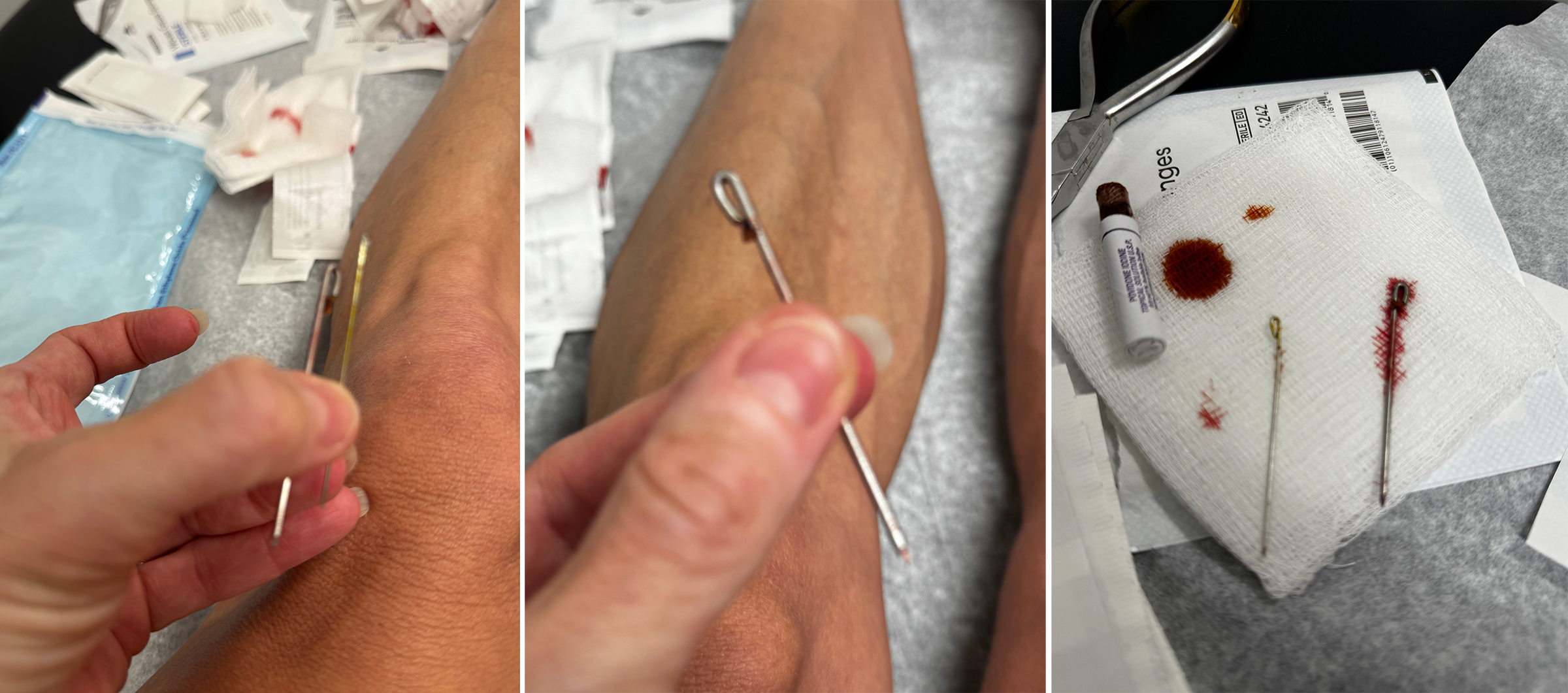 A three-panel photo of the pin extraction. Left: fingers pinch a thin metal pin poking out of the top of the foot. Center: a close-up of the looped end of a pin gripped between fingers as it's eased out. Right: the two extracted pins lying on gauze beside a vial of iodine, with small smears of blood and orange antiseptic.