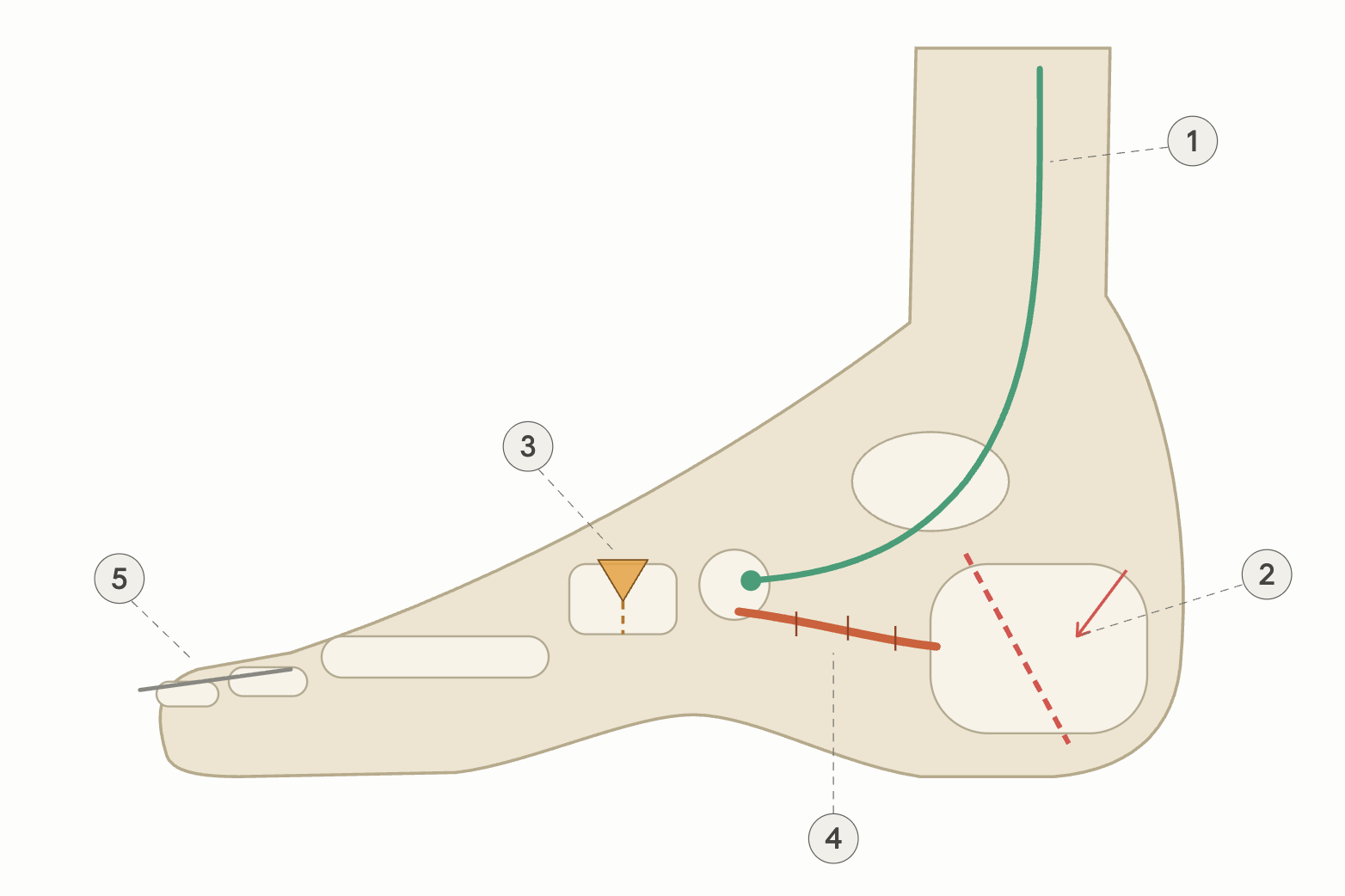 Side-view diagram of a right foot showing five numbered surgical procedures: a teal tendon rerouted from the leg to the arch, a red dashed cut line through the heel bone, an amber wedge in the midfoot, a stitched red-orange line under the ankle, and a gray wire through the second toe.
