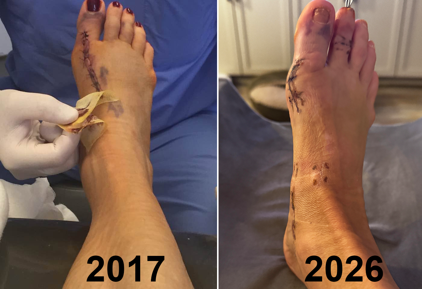 A side-by-side comparison of the same right foot nine years apart. Left, labeled 2017: a gloved hand peels surgical tape away from a long sutured incision running down the top of the foot. Right, labeled 2026: the same foot four weeks post-op, showing a healing incision over the midfoot and small puncture marks near the ankle, with faint older scarring where the 2017 hardware once was.