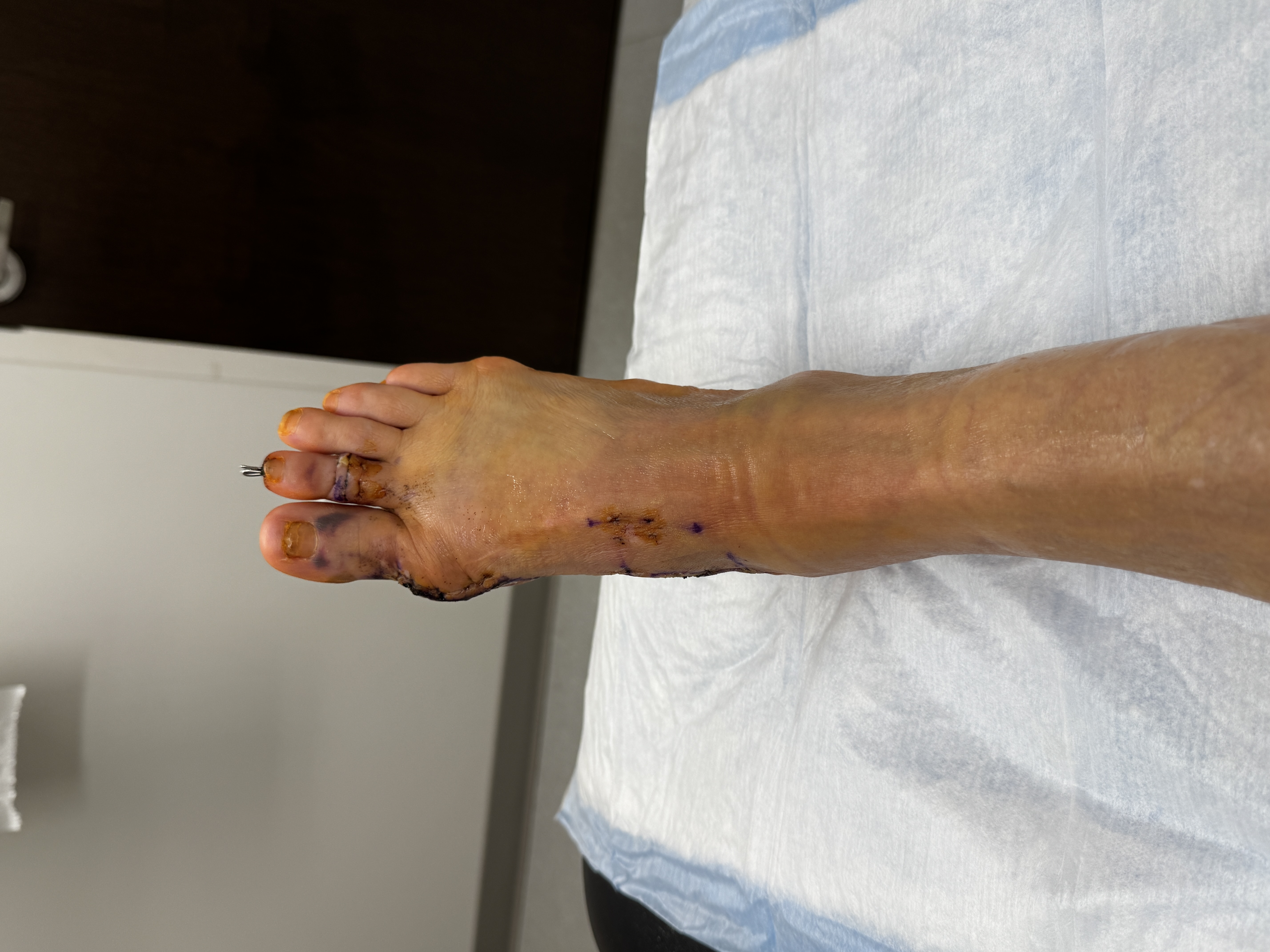 The full top-down view: every suture line freshly de-threaded, purple marker and yellow bruising slowly fading, bruised toes, and the pin still standing proudly out of my second toe.