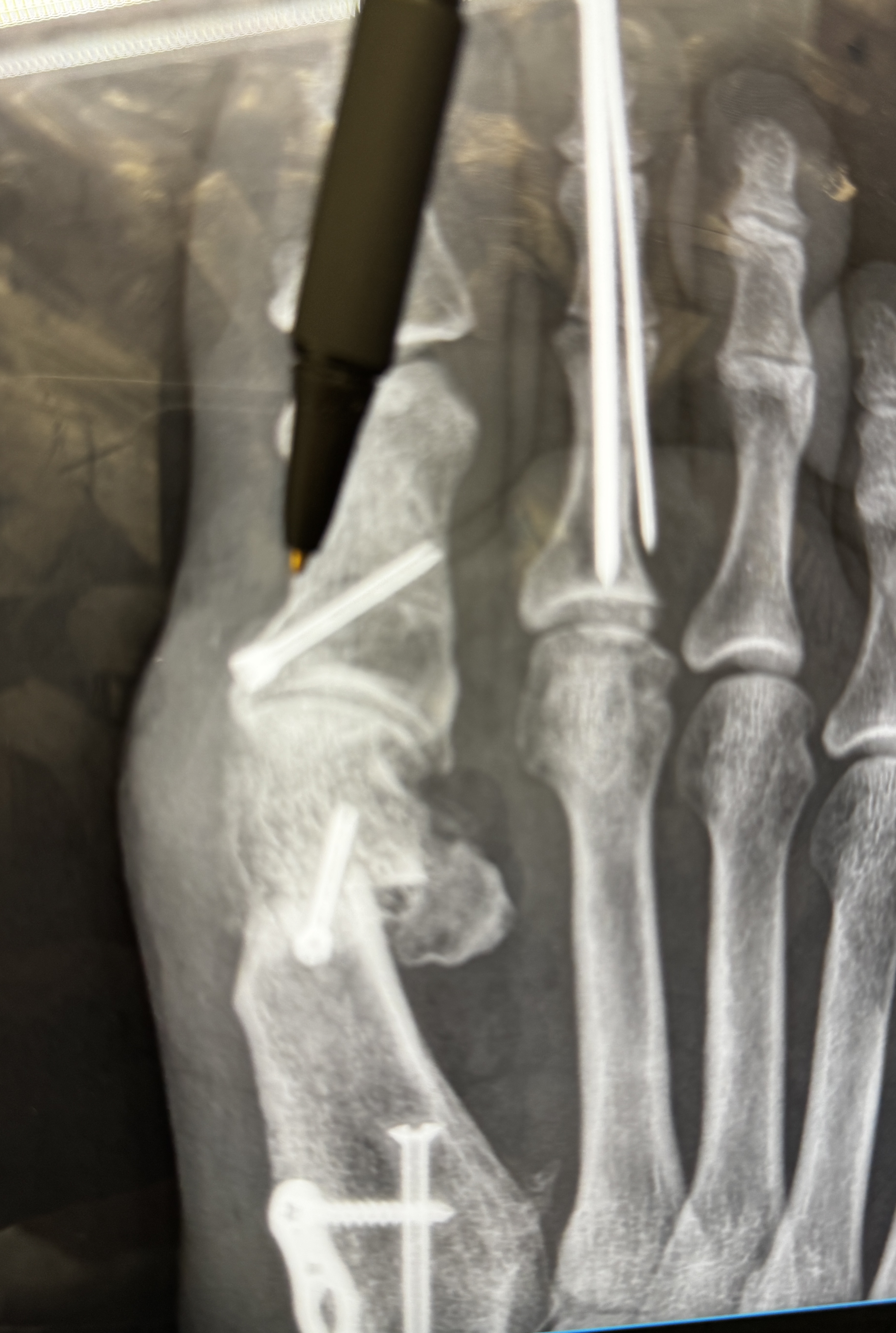 A top-down x-ray of the right forefoot with a black marker pen laid across it for scale. A screw angles through the base of the big toe where the bunion was corrected, a wire pin runs up the second toe, and a small plate and screws sit lower along the inside of the foot.