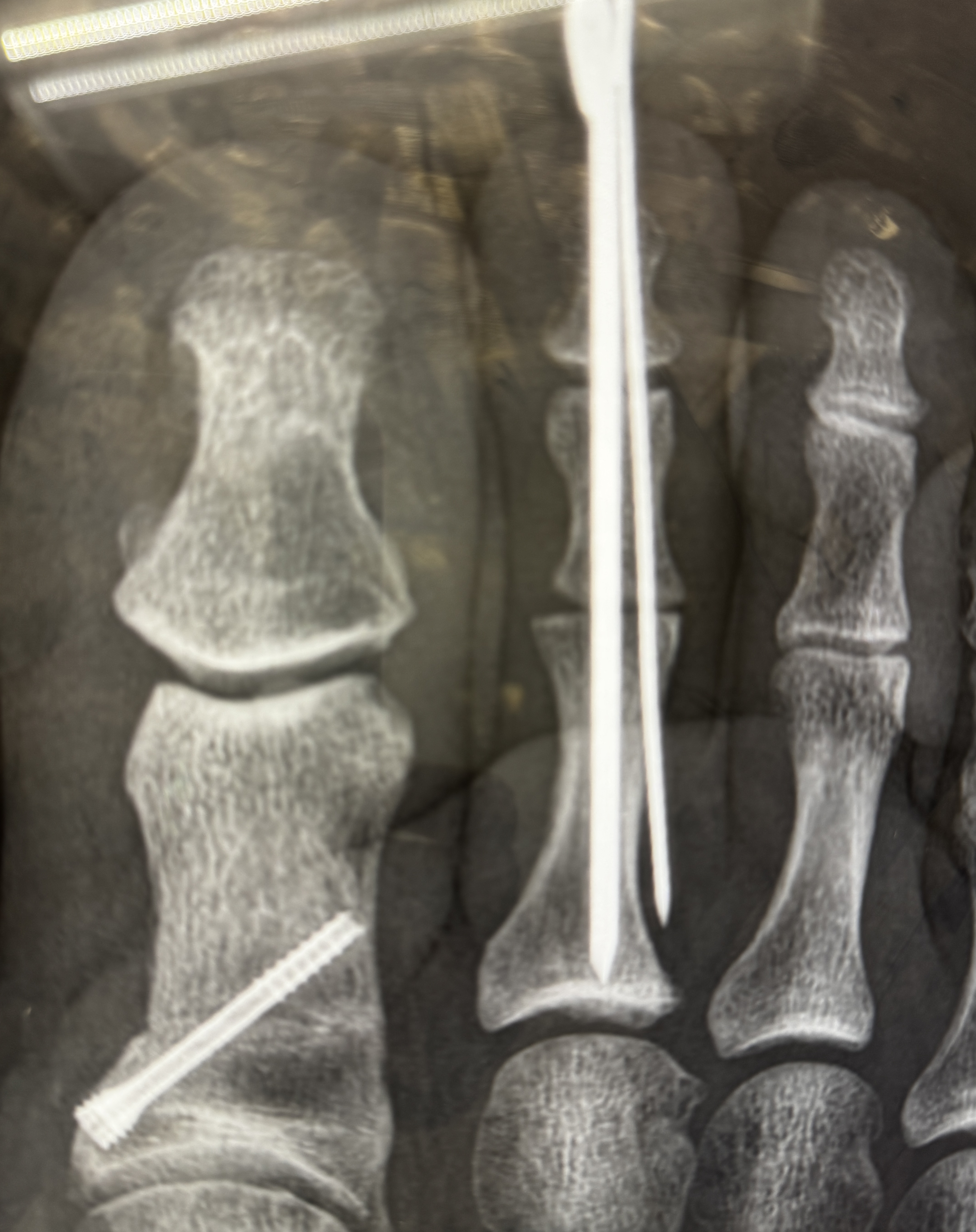 A close top-down x-ray of the toes: a long, thin wire pin runs straight up the second toe, and a single screw angles through the base of the big toe. The neighboring toe joints are visible in soft grey.