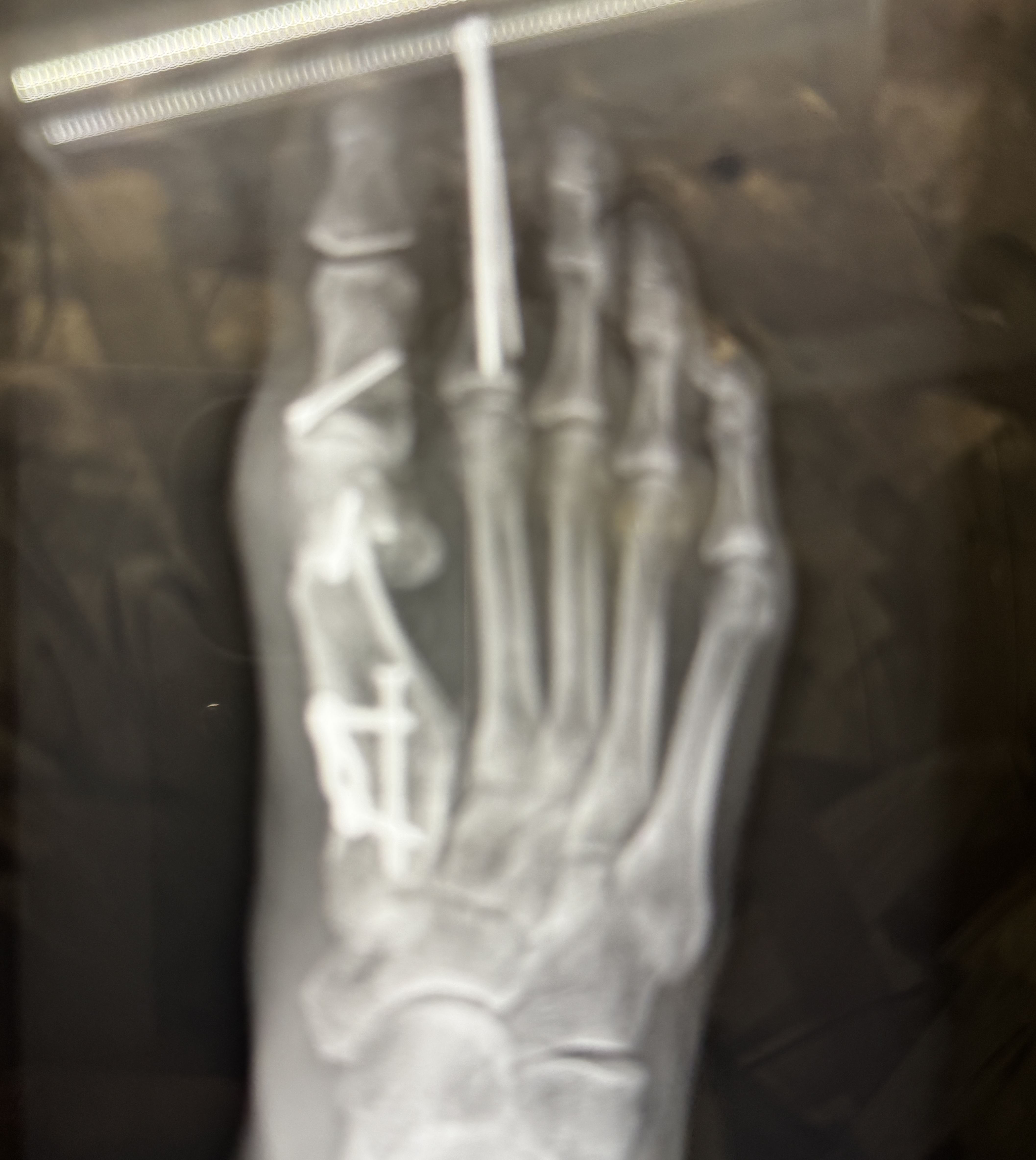 A softly blurred top-down x-ray of the whole right foot: the pin stands up out of the second toe, screws and a small plate line the big-toe side, and the five metatarsals fan down toward the heel.