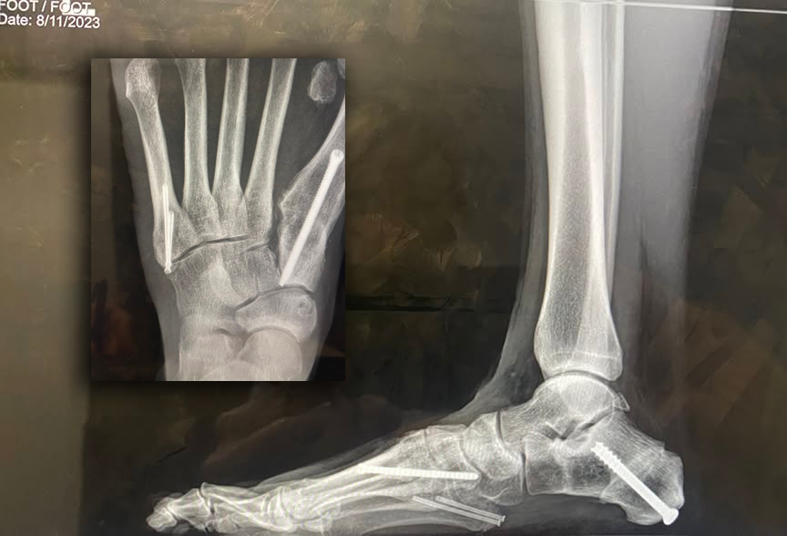 A lateral x-ray of a foot and ankle dated 8/11/2023, with long bright-white surgical screws running through the midfoot and heel. An inset shows a top-down view of the same foot, revealing two smaller screws set into the fifth metatarsal along the outer edge.